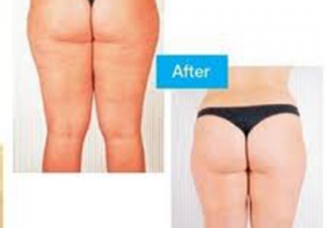 Cavi Lipo Before-After 2