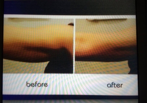 Cavi Lipo Before-After 8