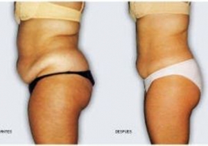 Cavi Lipo Before-After 1