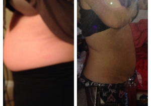 Cavi Lipo Before-After 10