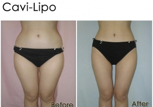 Cavi Lipo Before-After 3