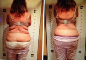 Cavi Lipo Before-After 4