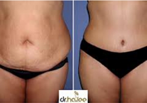 Cavi Lipo Before-After 5