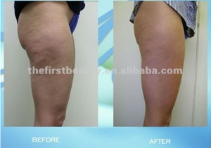 Cavi Lipo Before-After 6