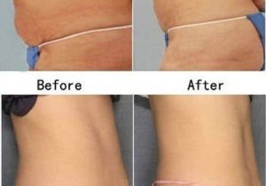 Cavi Lipo Before-After 7