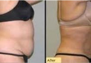 Cavi Lipo Before-After 9